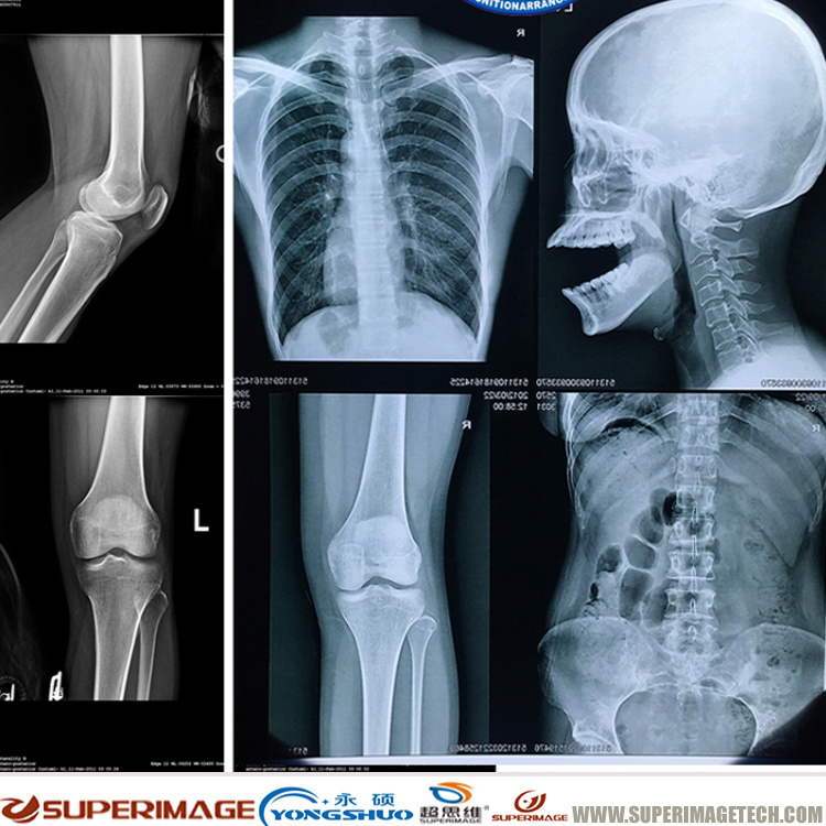 Xray Film/Blue Xray Film/Inkjet Xray Film/Xray Film 8"*10"/Xray